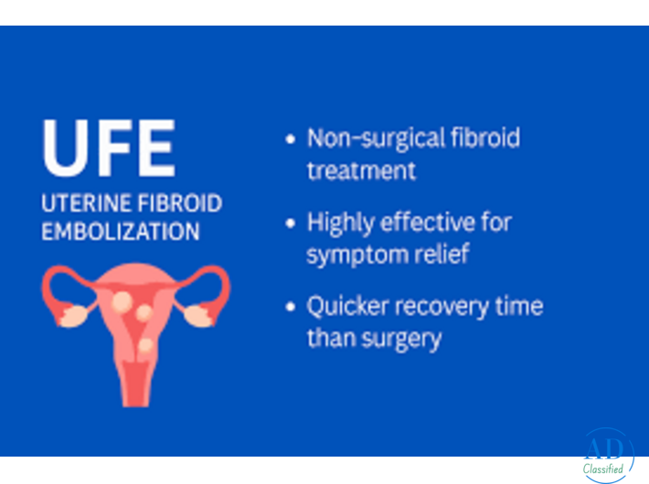 UFE Treatment Method for Women Wanting Fibroid Removal