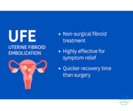 UFE Treatment Method for Women Wanting Fibroid Removal