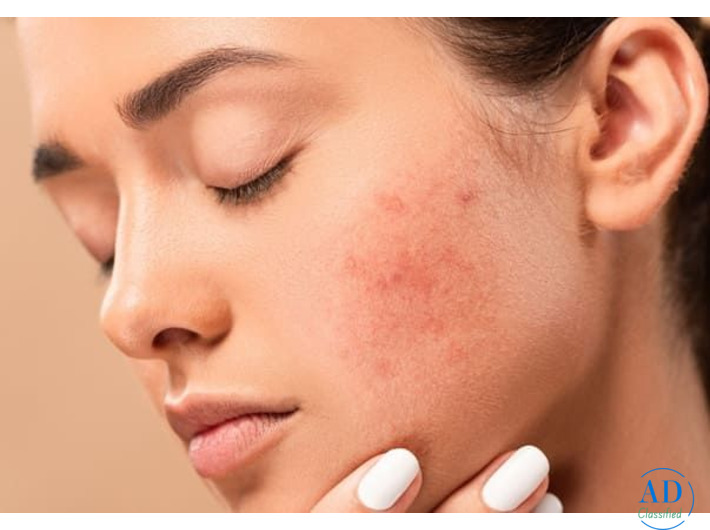 Best Acne Treatment in Hyderabad - FMS Skin & Hair