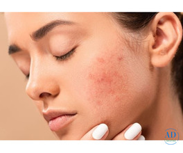 Best Acne Treatment in Hyderabad - FMS Skin & Hair