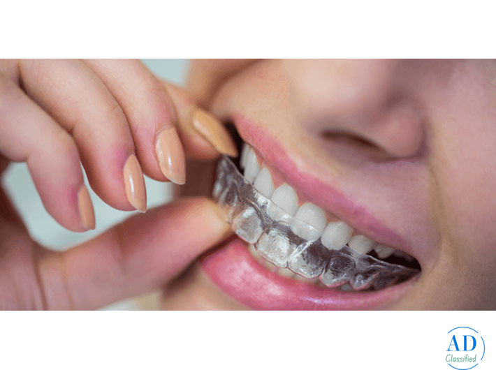 Looking for Teeth Aligners in Mullanpur? Visit Forever Smiles Dental & Implant Centre