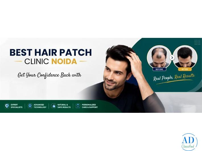Best Hair Patch Clinic in Noida | Apolo Hair Studio