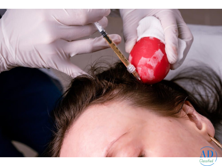 Top benefits of getting PRP Treatment in Dubai