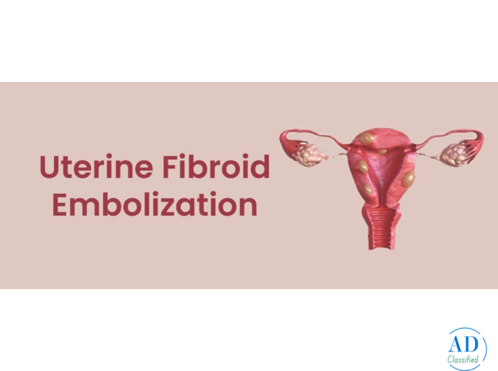 UFE Treatment for Fibroids | Minimally Invasive Care