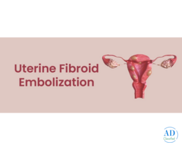 UFE Treatment for Fibroids | Minimally Invasive Care