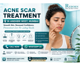 Acne scar treatment in Andheri West, Mumbai