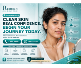 Acne Scar Treatment in Banjara Hills, Hyderabad