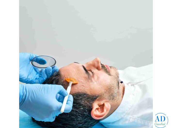 Best Chemical Peel Treatment in Bengaluru