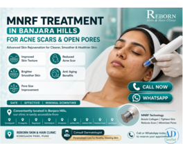 Expert MNRF Treatment near Jubilee Hills, Hyderabad for Acne Scars &amp; Skin Rejuvenation