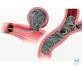 Coiling Procedure for Brain Aneurysm Safe & Minimally Invasive Treatment IRFacilities