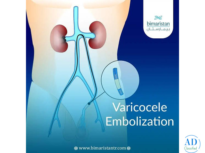 Best Varicocele Treatment: A Modern, Minimally Invasive Solution