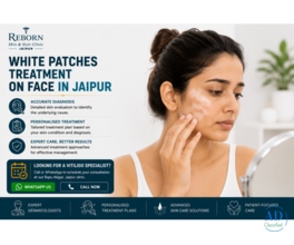 Facial White Patches Getting Noticeable? Consult Jaipur Skin Experts