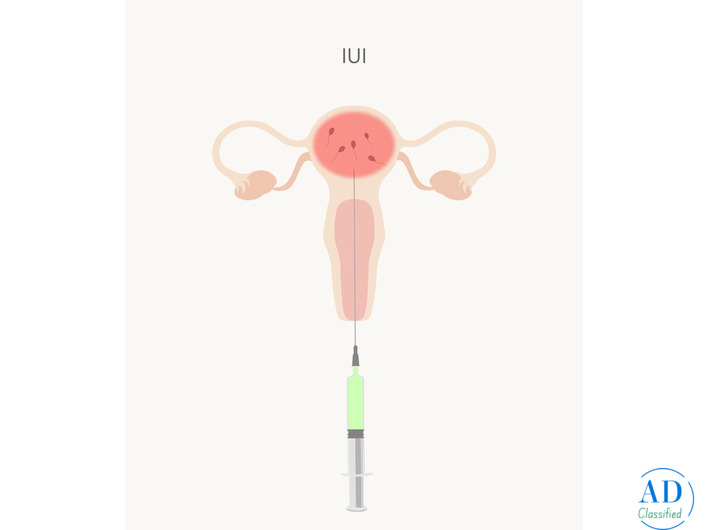 IUI Centre in Noida: Complete Guide to IUI Treatment in India
