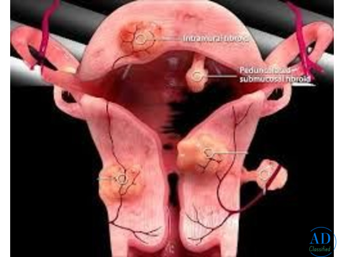 UFE Treatment for Uterine Fibroids | Advanced Non-Surgical Care