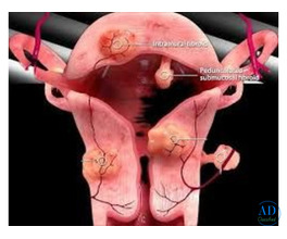 UFE Treatment for Uterine Fibroids | Advanced Non-Surgical Care