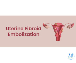 Uterine Fibroid Embolization Cost in India – Know the Treatment Expenses