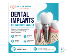 Dental Implants in Chandigarh | Molar Magic Dental Clinic – Sector 33