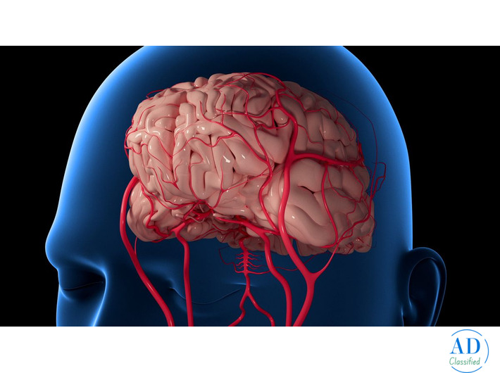 Aneurysm Coiling Treatment | Minimally Invasive Brain Aneurysm Care