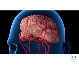 Aneurysm Coiling Treatment | Minimally Invasive Brain Aneurysm Care