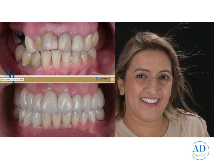 Dental Treatment in India for Foreigners