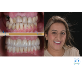 Dental Treatment in India for Foreigners