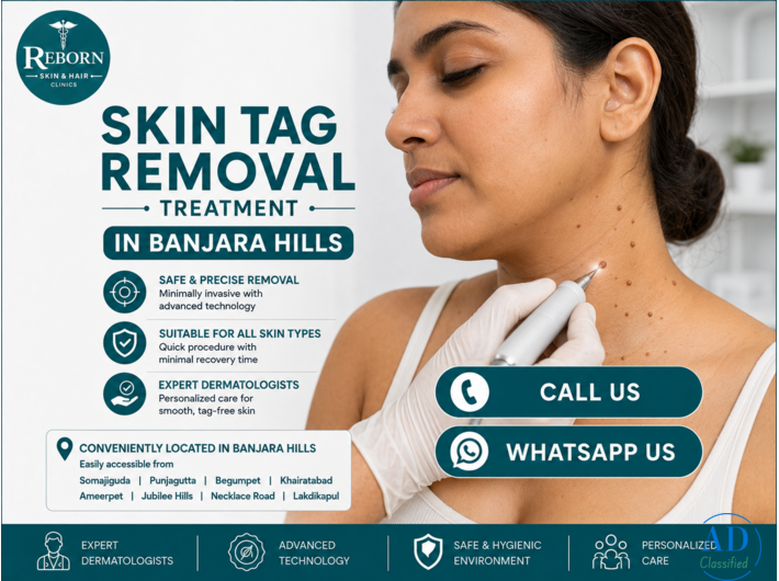 Skin Tag Removal in Banjara Hills – Dermatology Consultation Available