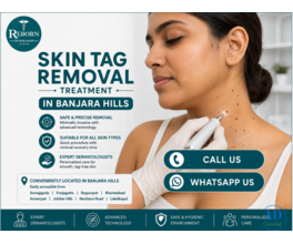 Skin Tag Removal in Banjara Hills – Dermatology Consultation Available