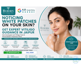 Vitiligo Treatment for White Spots on Face near Tilak Nagar Jaipur