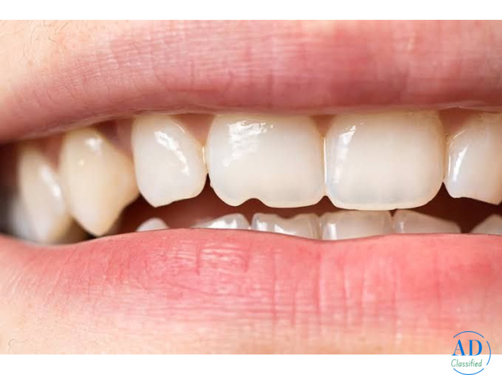 What are the options for fixing a chipped tooth?