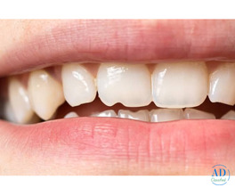 What are the options for fixing a chipped tooth?