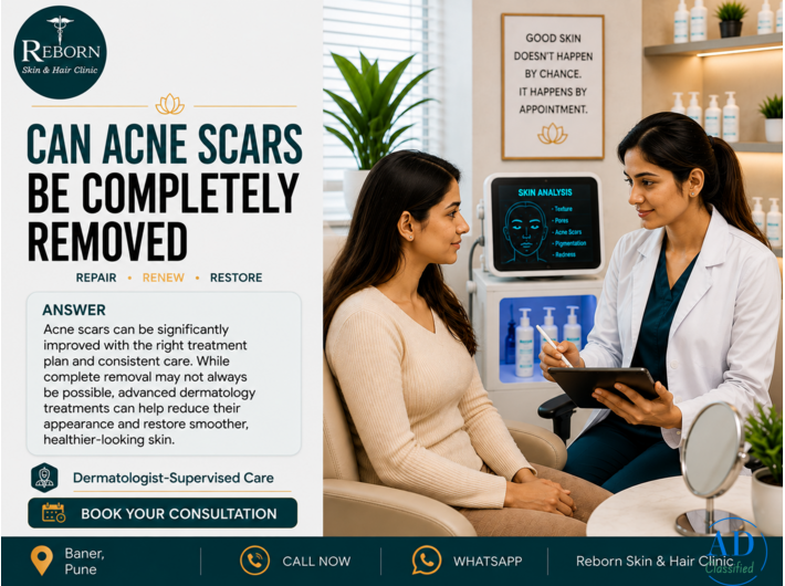 Acne Scar Treatment in Balewadi, Pune – Personalised Skin Care